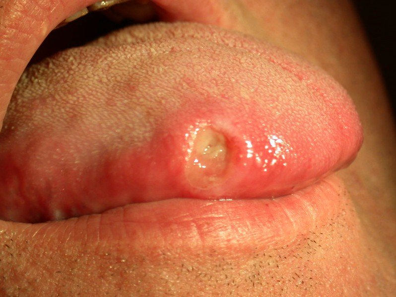 Aphthous stomatitis - Wikipedia