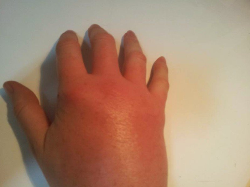 red-wasp-sting-swelling