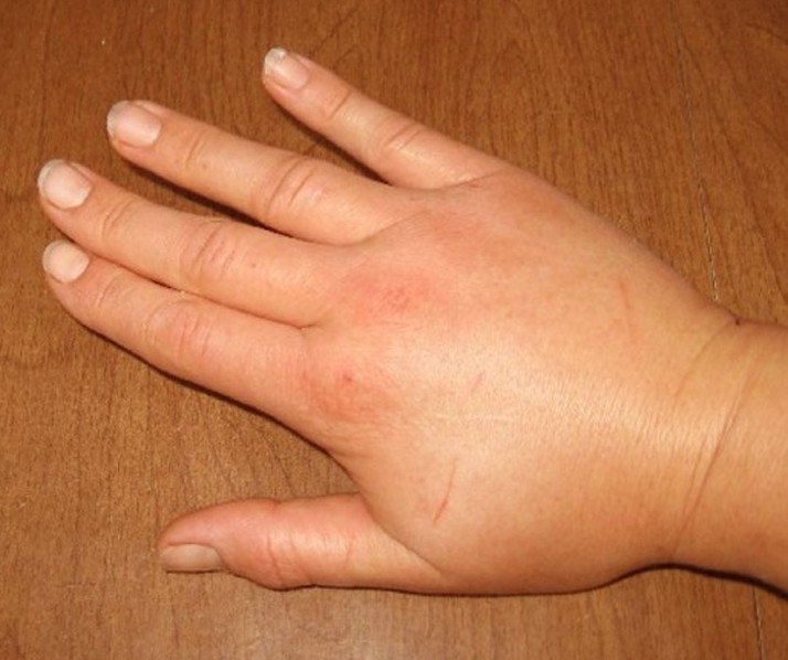 Bee & Wasp Sting: Treatment and First Aid - WebMD