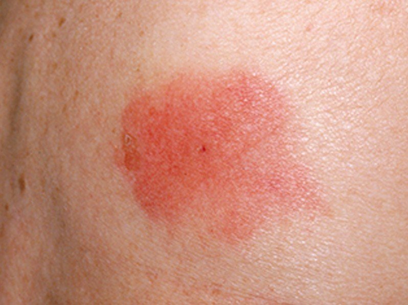 wasp-swelling-from-wasp-sting