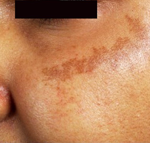 Brown Spots on Skin Pictures, Causes, Home Remedies