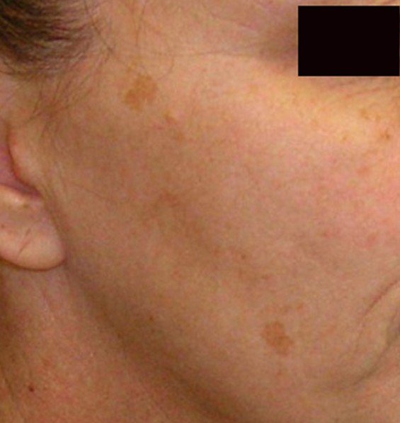 brown-spots-on-skin-pictures-causes-home-remedies-treatment