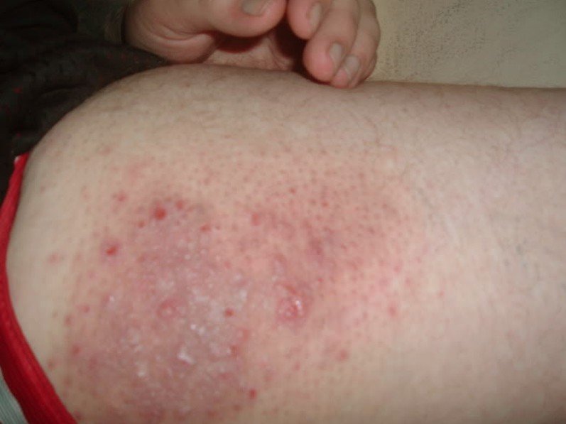 Folliculitis on inner thighs? - Dermatology - MedHelp