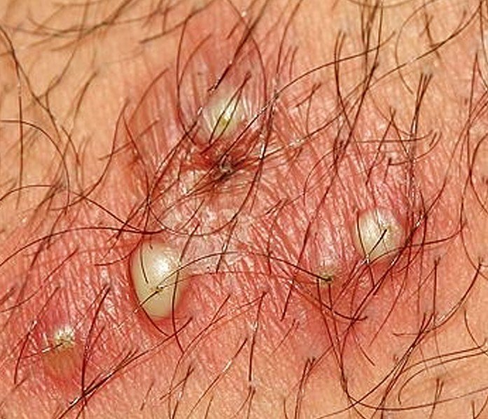 Herpes gladiatorum - Wikipedia