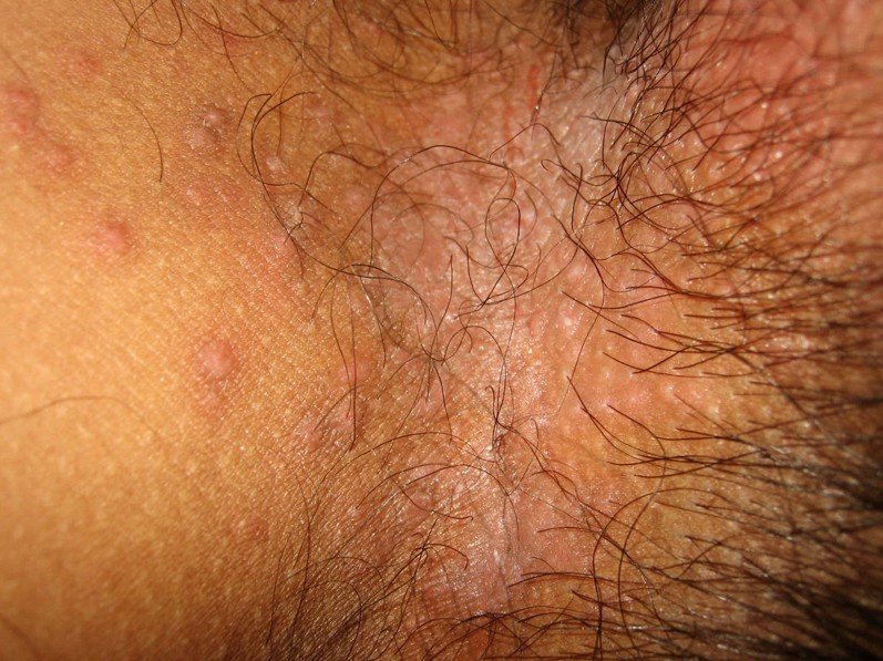 very itchy red blotchy rash on torso, legs arms, back, and ...