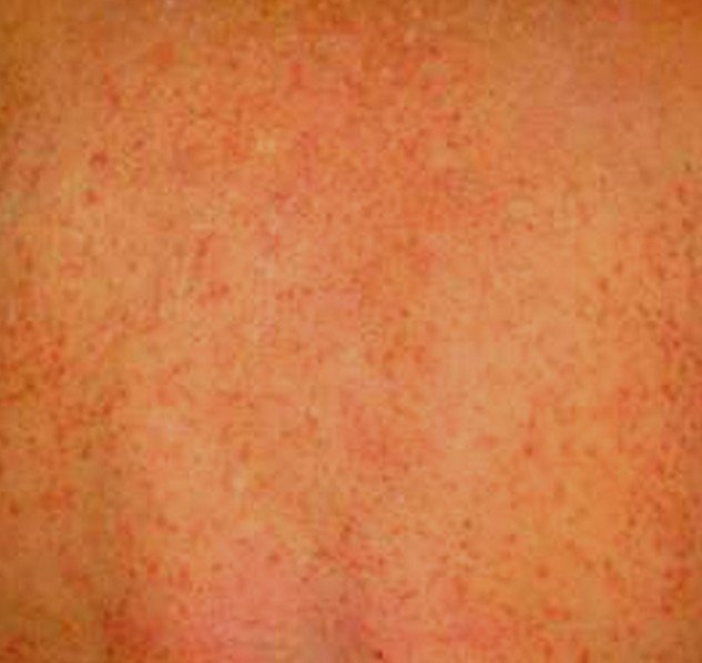 Chlorine Rash Pictures Causes And Treatments