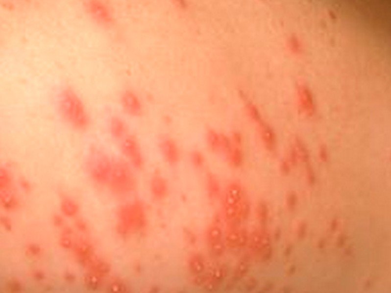 Skin Rash: 59 Pictures, Causes, Treatments - Healthline