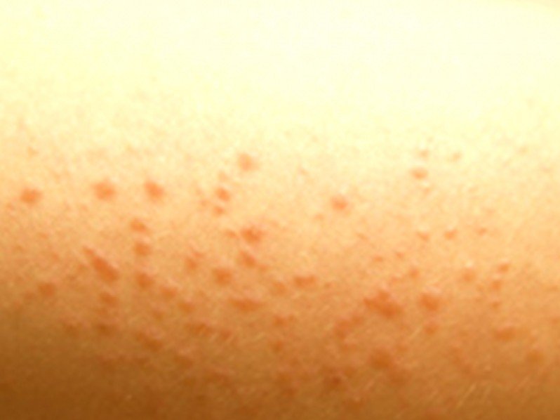 Chlorine Rash Pictures, Causes and Treatments