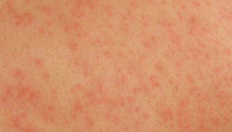 Slide show: Common skin rashes - Mayo Clinic