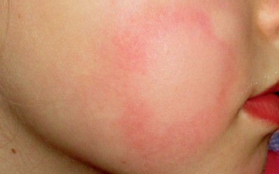Cold urticaria - Mayo Clinic