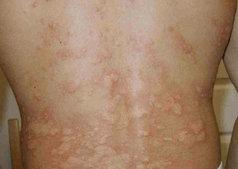 Cold Urticaria:: Treatment