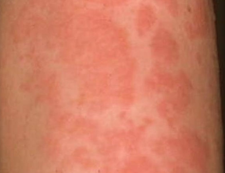 How to cure cholinergic urticaria - Quora
