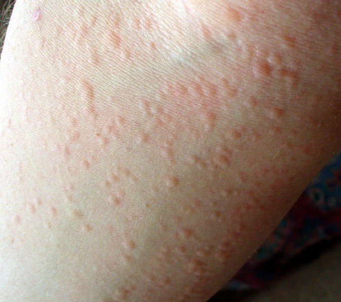 hives from cold