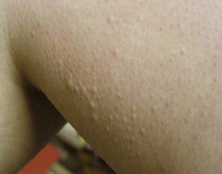 Urticaria Pictures, Images & Photos | Photobucket