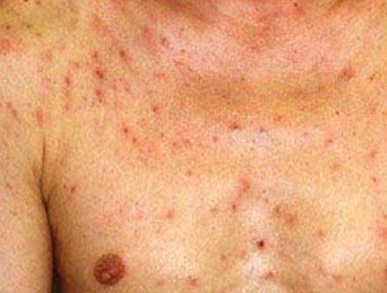 Folliculitis Causes, Symptoms, Treatments, Prevention