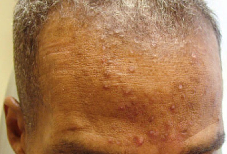 Eosinophilic Folliculitis Pictures Symptoms Diagnosis Treatment