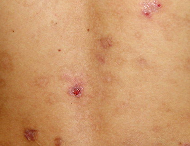 picture of folliculitis #11