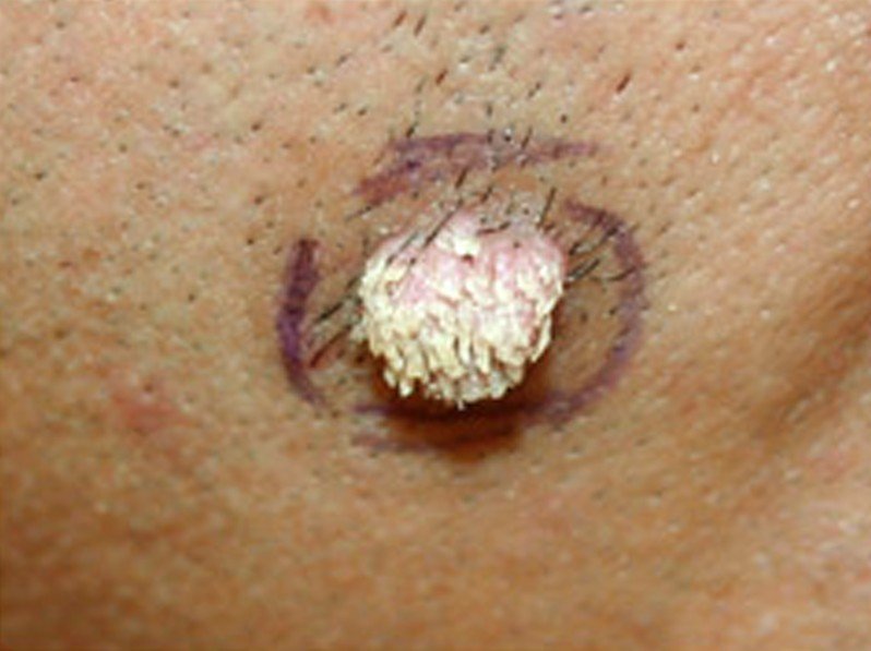 wart images