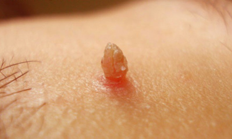 Wart - Wikipedia