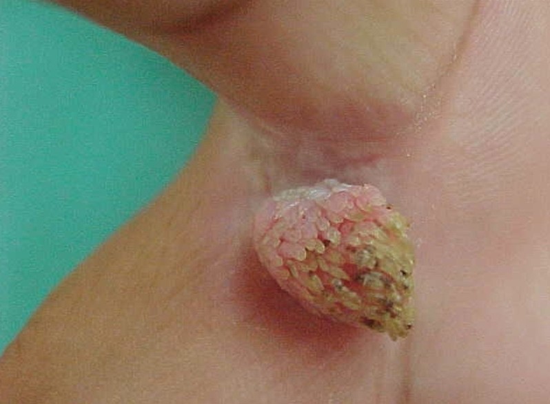 Common Warts: Learn About Symptoms, Treatment and Causes
