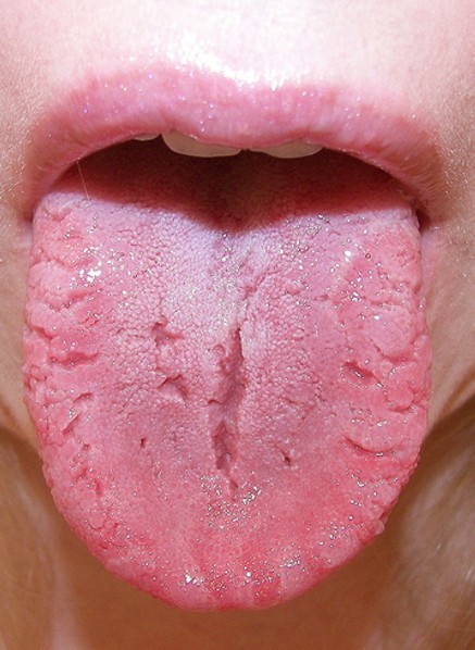 Fissured Tongue - AAOM