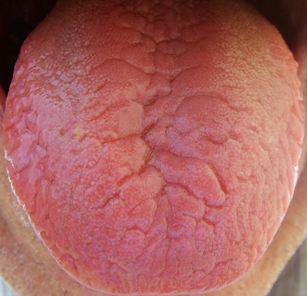 fissured tongue
