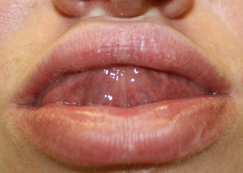 White Spots On Inside Corner Of Lips