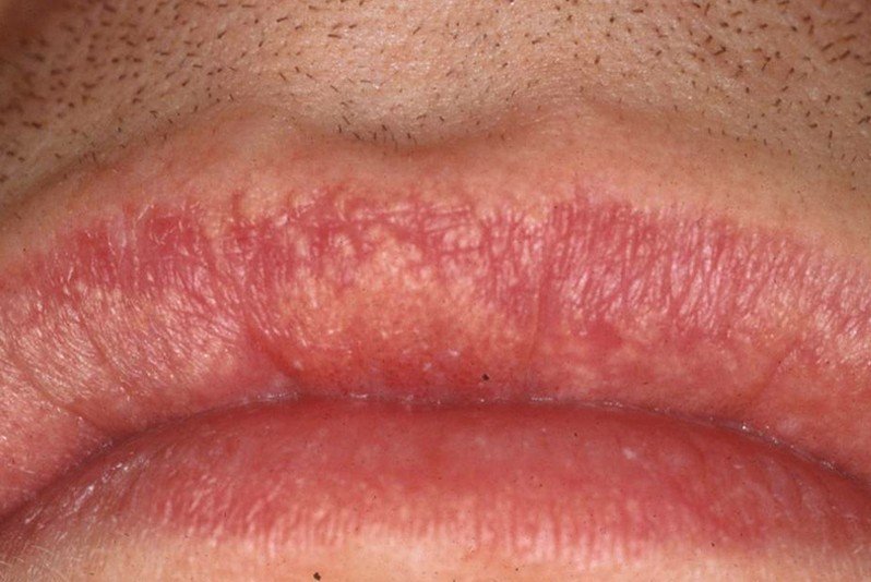 Fordyce spots – Causes, Symptoms, Treatment, Pictures