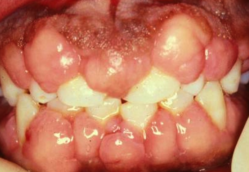 does dilantin cause gingival hyperplasia