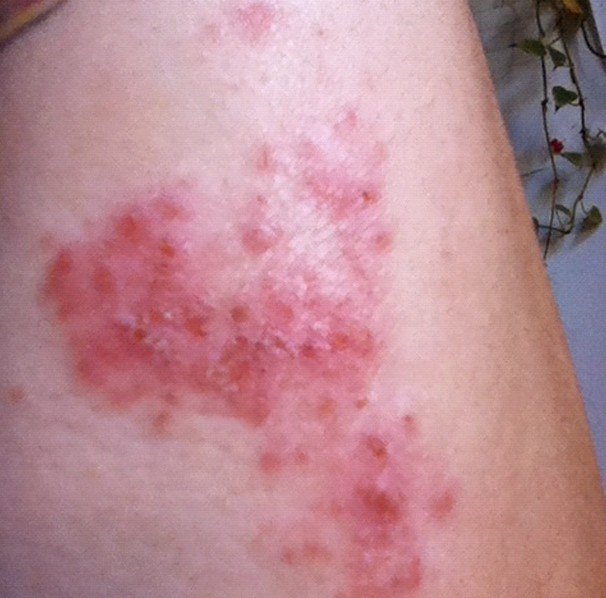 Itchy Skin Rash, Red Spots on Skin/Feet/Ears/Hands/Palms ...