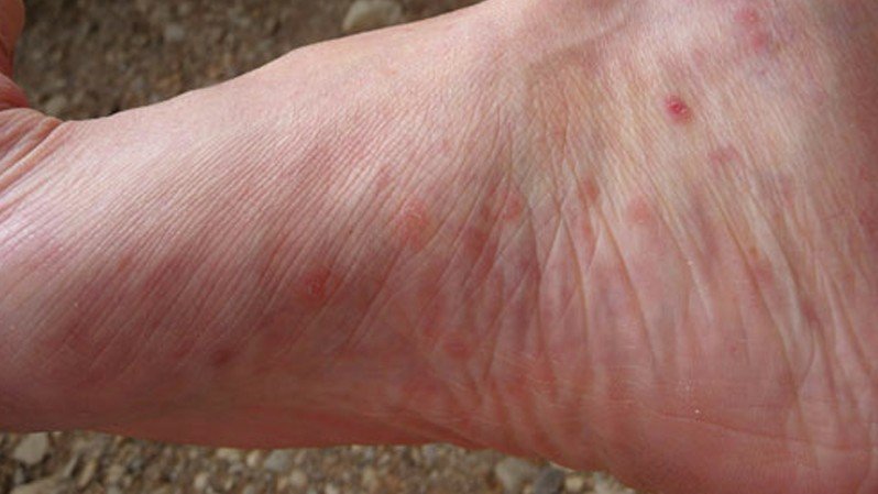 Itchy Big Toe | Foot Health Forum