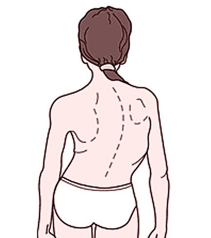 levoscoliosis pictures