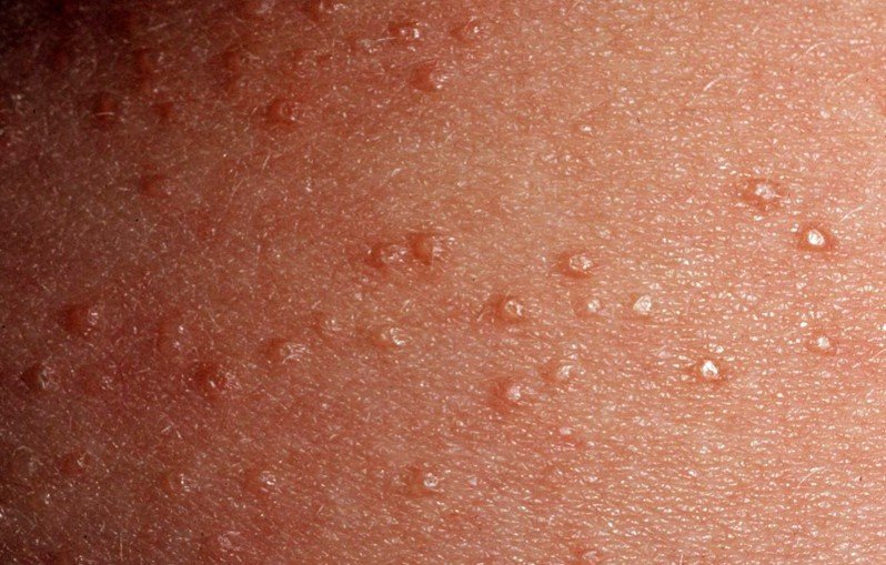 Lichen Nitidus Pictures Treatment Symptoms Causes