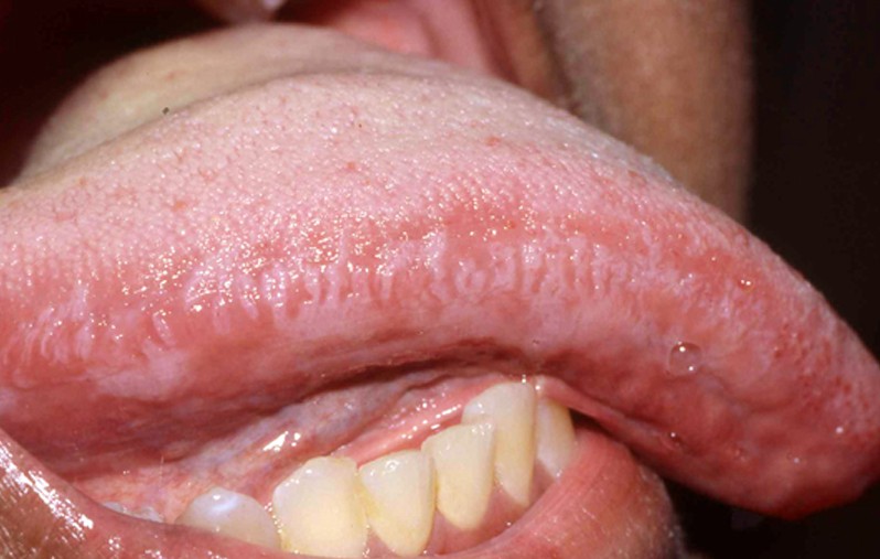 Hairy Leukoplakia Of Tongue 108
