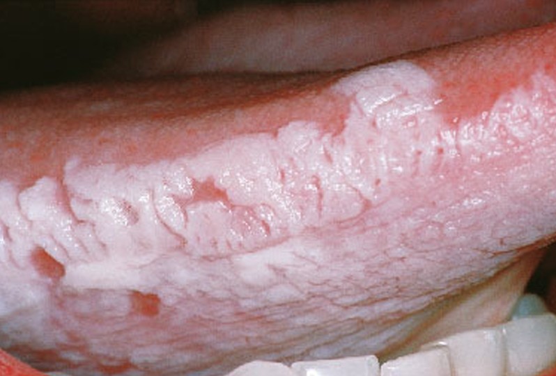 Oral Hairly Leukoplakia 91