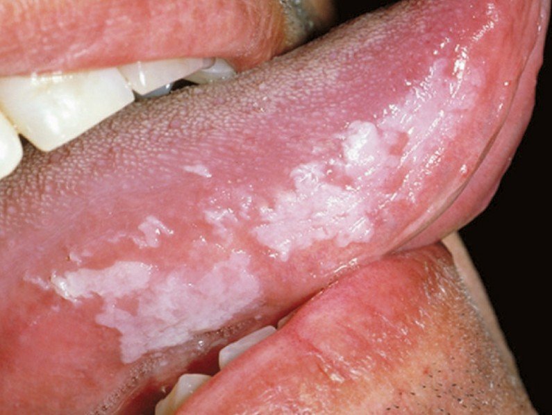 oral leukoplakia #11