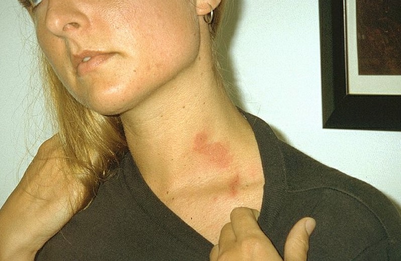 phytophotodermatitis pictures 3