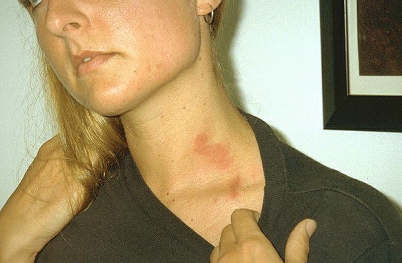 Picture of Phytophotodermatitis - WebMD