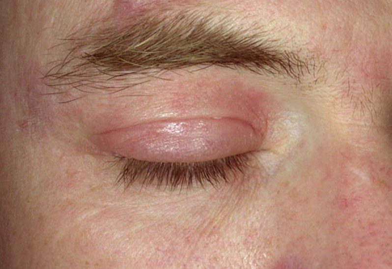 What Causes A Rash Around My Eyes