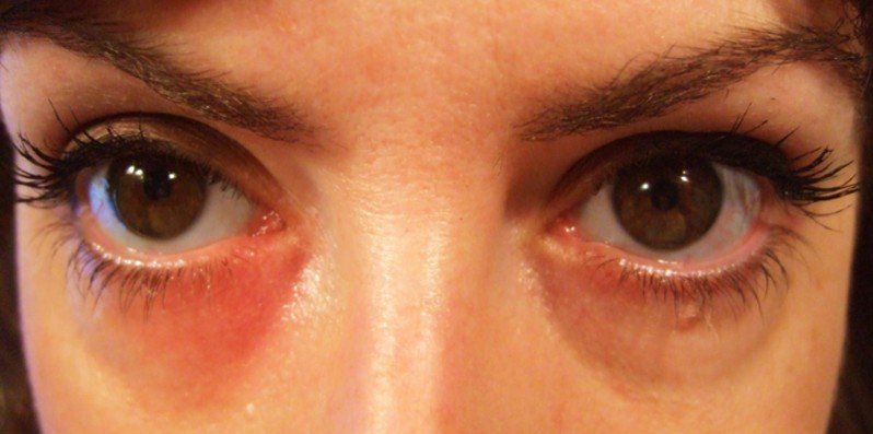 Rashes Around Eyes Pictures Pictures Photos 