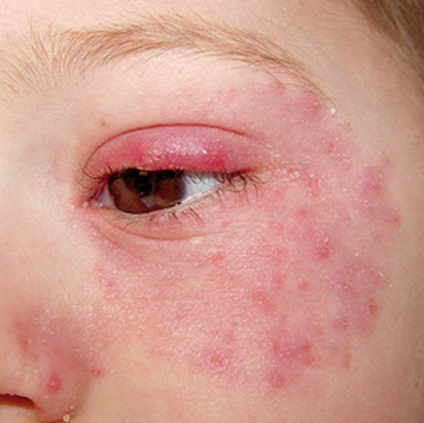 Eyelid redness, Skin irritation, Skin rash and Skin ...