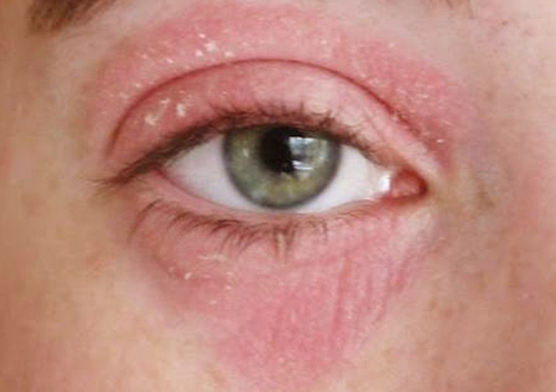 Rash Around the Eyes: How to Treat It? | Med-Health.net