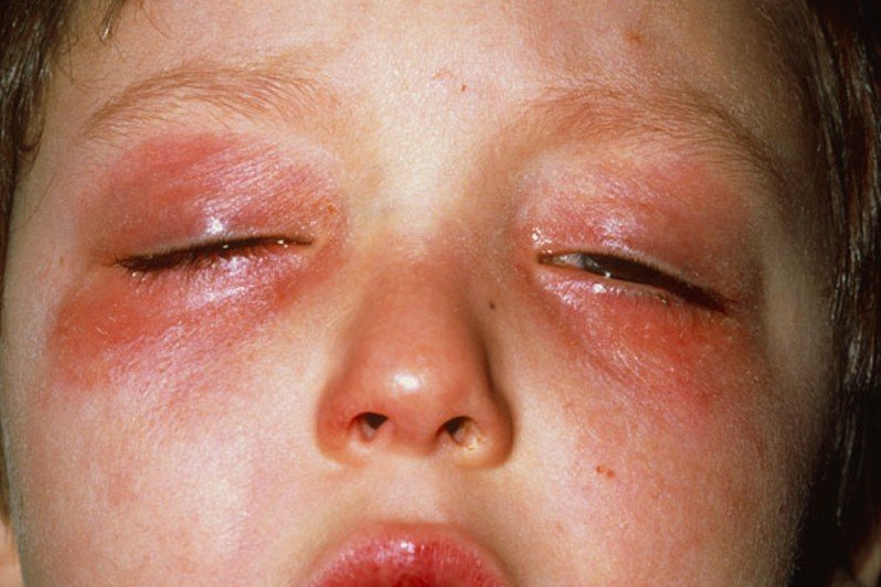 Rash around the Eyes: Causes and Natural Treatments