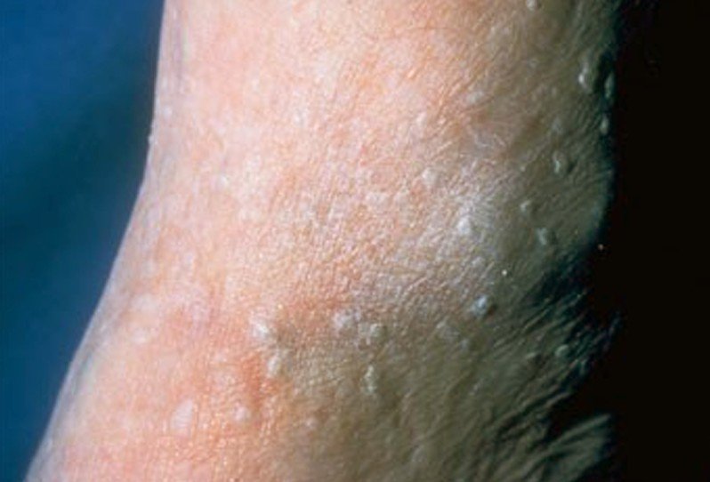 Stucco Keratosis Treatments | Seborrheic Keratosis