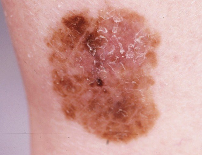 Malignant Melanoma Types A Superficial Spreading Melanoma B Images