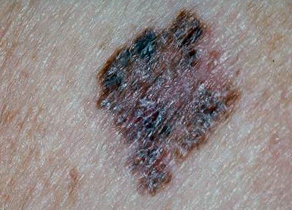 superficial spreading melanoma pictures 4