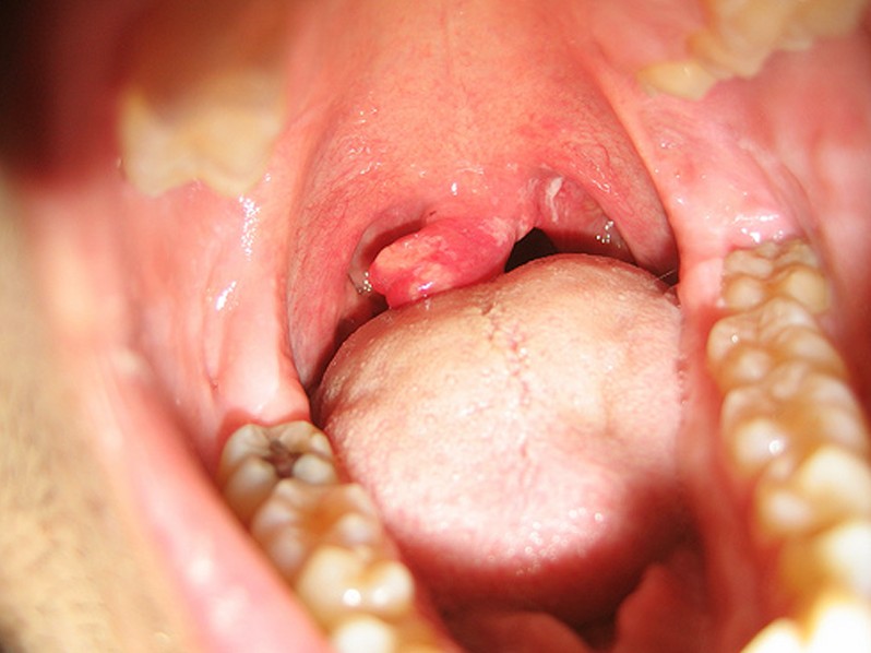 Throat Swollen Uvula 52