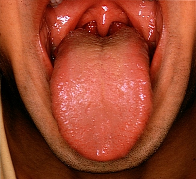 What causes a sore tongue and tongue bumps ? - WebMD