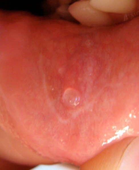 Blister Inside Mouth 56