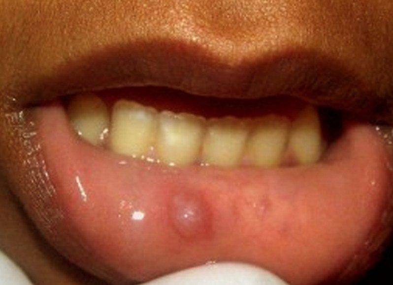 What Does Bumps Inside Your Mouth Mean